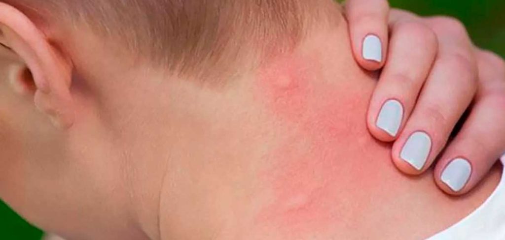 Prevenir picaduras de mosquitos