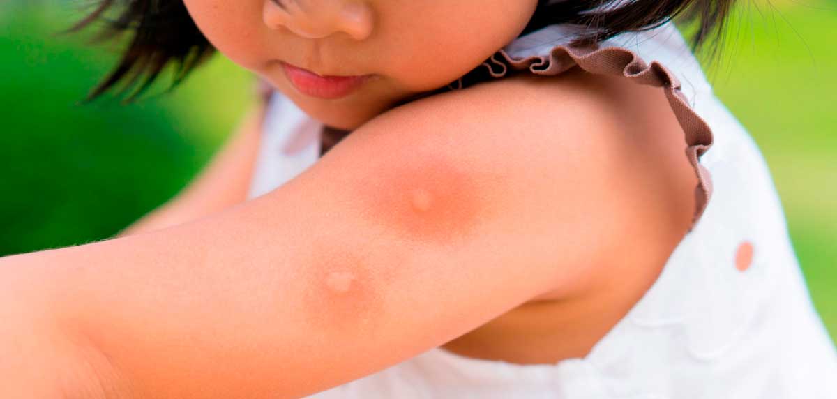 Tratamiento para picaduras de mosquitos en bebés y niños